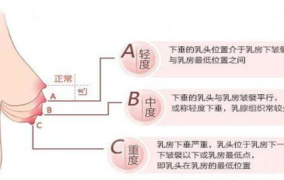 胸大可以做缩小手术吗,重塑胸型，重拾自信之美